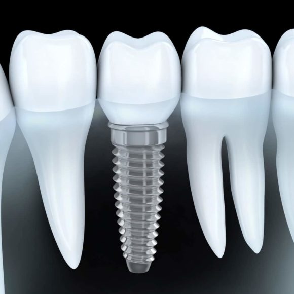 Implantologia dentara